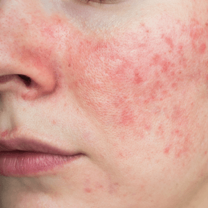 Redness / Rosacea