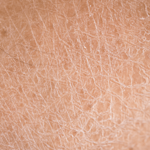 Dry / Dehydrated Skin