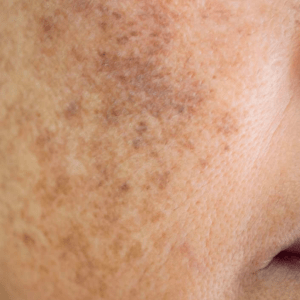 Uneven Skin Tone